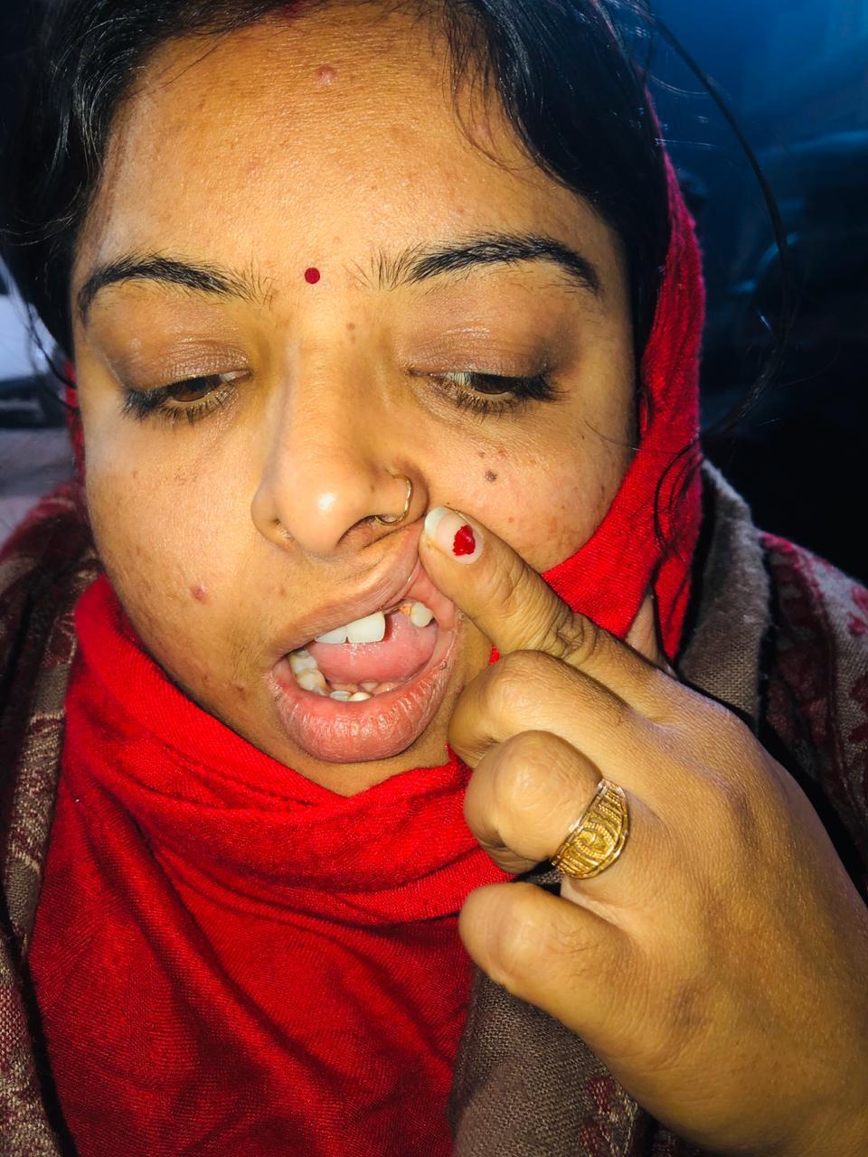 कूड़ा फेकने से मना किया तो दबंग ने तावे से किया महिला टीचर पर हमला दांत टूटा